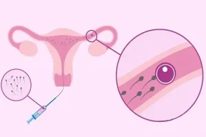 试管婴儿「方案详解」：什么是自然周期？