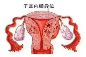 子宫内膜异位症为什么会引发不孕？