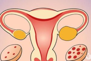 多囊卵巢患者到底应该怎么办?