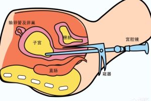 试管婴儿移植前，为什么医生会让你去做宫腔镜？