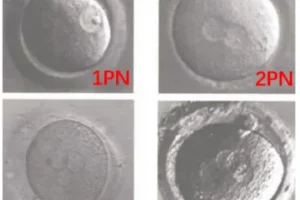 医生常说的：2PN、0PN、1PN是什么意思？有什区别？