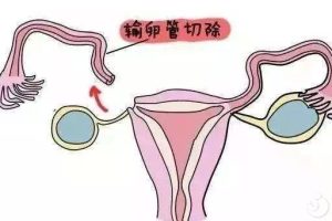 输卵管切除后怎么办？可以做试管婴儿吗？