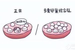 多囊卵巢想怀孕怀不上教你三招