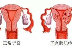 腺肌症对怀孕的影响，你不会还不知道吧?