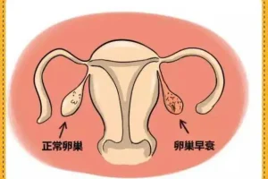 卵巢早衰有三个等级，你在哪一级