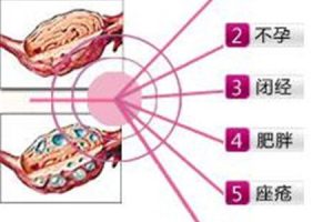 多囊卵巢综合征，说白了就是一碗猪杂汤！
