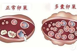 多囊卵巢不运动不治疗，会导致不孕？