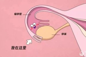 输卵管堵塞了，该选择吃药还是做手术呢？
