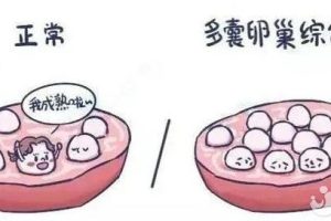 什么是多囊卵巢综合征？其主要的临床表现是什么？
