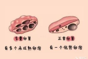 什么是多囊卵巢综合征？“多囊”妈妈如何拥有自己的宝宝？