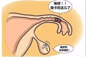 输卵管堵塞的原因是什么，有哪些症状？