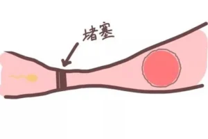 为什么会怀不上？可能是输卵管堵塞，看看有没这些症状