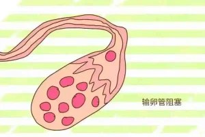 输卵管为何会阻塞？有什么预防措施？