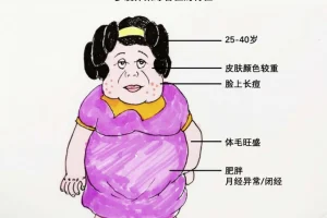 多囊卵巢综合征科普知识:诊断标准~表现症状~
