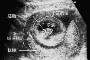 生化妊娠是什么，生化妊娠会排出孕囊吗？生化后多久可以怀孕？