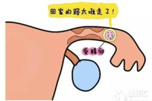 造成现代女性宫外孕的原因有哪些？要怎么预防？