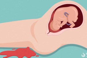 瘢痕妊娠是什么？剖腹产的试管妈妈一定会有？真的假的？