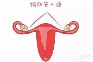 女性要能避开这3件事，或许能避免输卵管堵塞