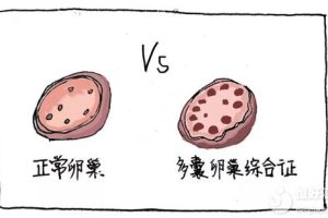 多囊卵巢综合征容易生双胎？这几点知识了解一下！