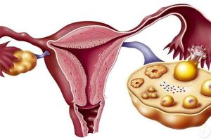 哪些女性朋友容易患有子宫肌瘤？子宫肌瘤分为哪几类？求解！