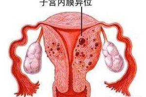 患有子宫内膜异位症，会影响生育吗？
