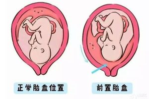 解密大时刻：探一探孕早期为何出血（四）