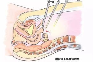 腹腔镜从腹部穿刺检测，会不会留疤？