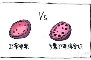 患上多囊卵巢综合征，会发生什么变化呢？