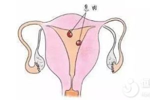 子宫内膜息肉是什么样的疾病，会影响生育吗？