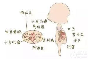 患上急性附件炎会很严重吗？