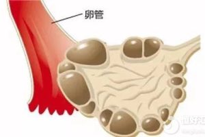 多囊卵巢综合征最惦记肥胖人群，是真的吗？