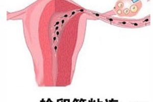 怎么办？输卵管又粘连了