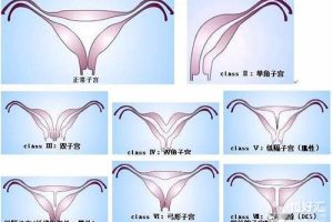 子宫畸形疾病，你了解多少？