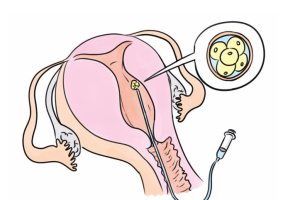 冻胚移植在上午还是下午进行？内膜会变化么？
