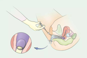 第三代试管婴儿费用大概要多少钱