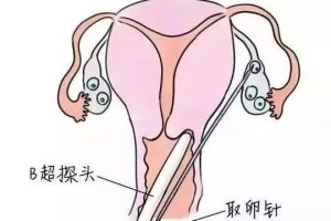 性做试管婴儿疼吗？