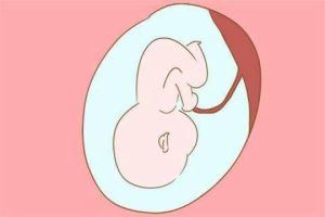 试管婴儿双胞胎应不应该减胎？