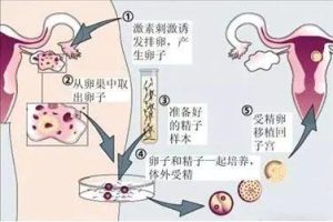 试管婴儿的具体步骤