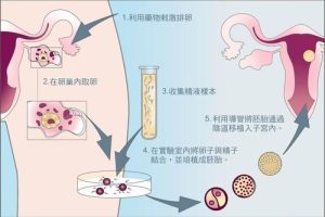 泰国试管婴儿都有哪些流程