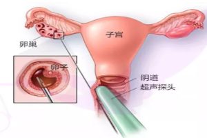 试管婴儿取卵过程全攻略