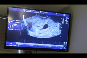 高龄孕妇怎么预防难产