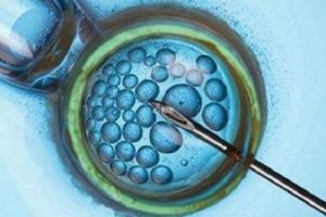 多囊不孕怎么回事还可以做试管婴儿吗