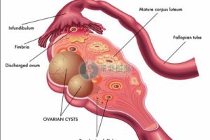 宫腔粘连不孕该怎么办还可以选择试管婴儿吗