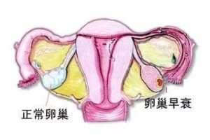 输卵管堵塞是什么原因造成的？