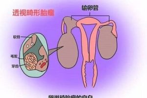输卵管结扎复通术要注意什么？