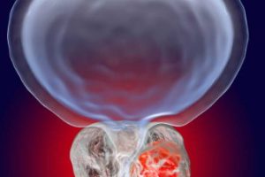 子宫内膜异位症是什么，子宫内膜异位症有哪些症状，子宫内膜异位症的治疗方法