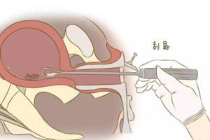 喝咖啡对惠州试管婴儿的成功率有影响吗？备孕期间喝咖啡会有什么风险？