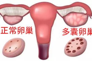 tsh0.3会对试管促排卵产生影响吗？