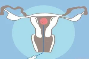 没有优势卵泡的情况下可以打排卵针吗?需要调理多长时间?