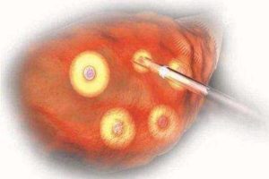 精子多种异常指数MAI的正常范围是什么